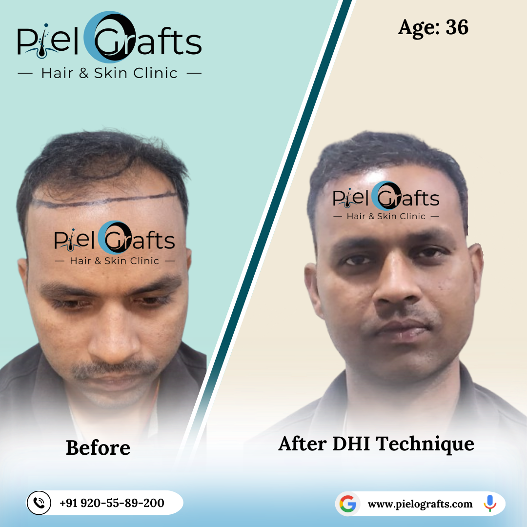 hair transplant side effects