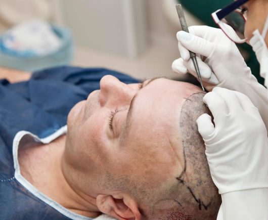 Hair Transplant Hair Transplant