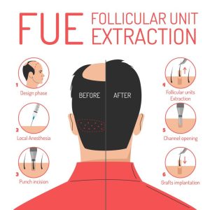FUE Hair Technique
