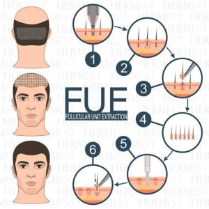 FUE Hair Transplant