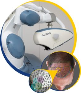 Robotic Hair Transplant